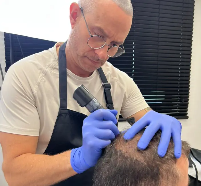 Praticien réalisant une tricopigmentation capillaire sur vertex dégarnie