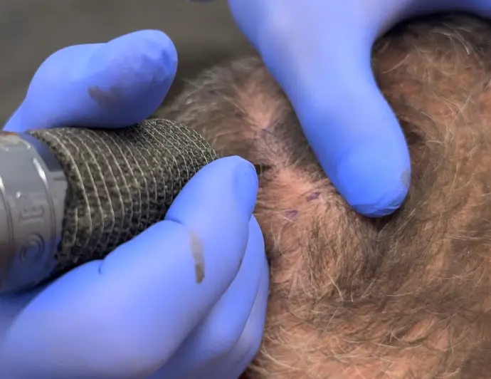 Détail d’une séance de pigmentation capillaire avec aiguille fine sur cuir chevel