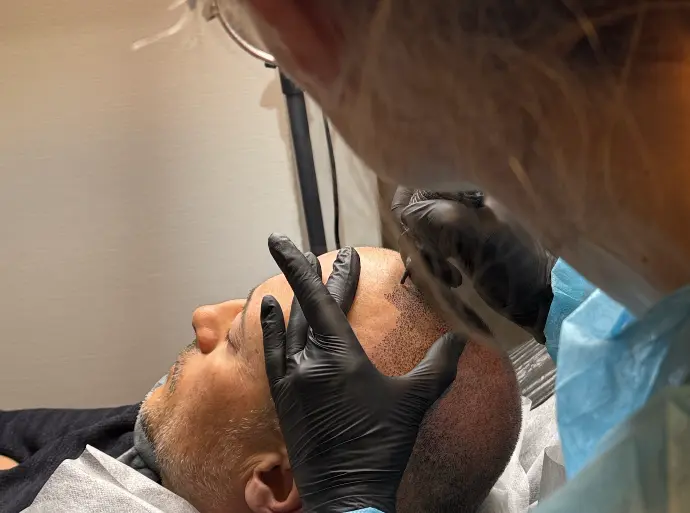 Technicienne réalisant une tricopigmentation capillaire avec gants noir et dermographe