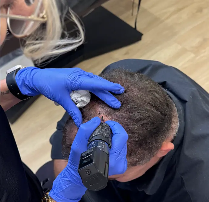 Détail d’une séance de pigmentation capillaire avec aiguille fine sur cuir chevel