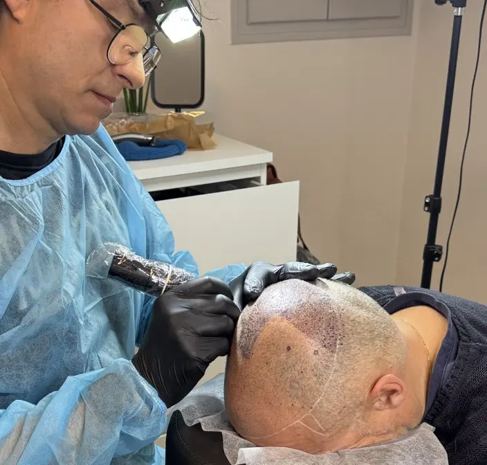 Praticien réalisant une tricopigmentation capillaire sur vertex dégarnie