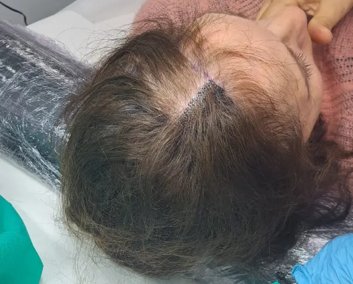 Pigmentation capillaire après raie médiane clairsemée pour effet densité naturelle