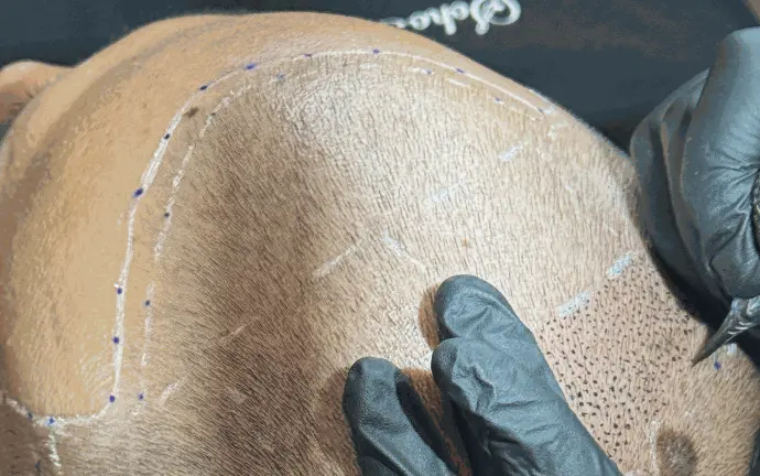 Praticien réalisant une tricopigmentation capillaire sur vertex dégarnie