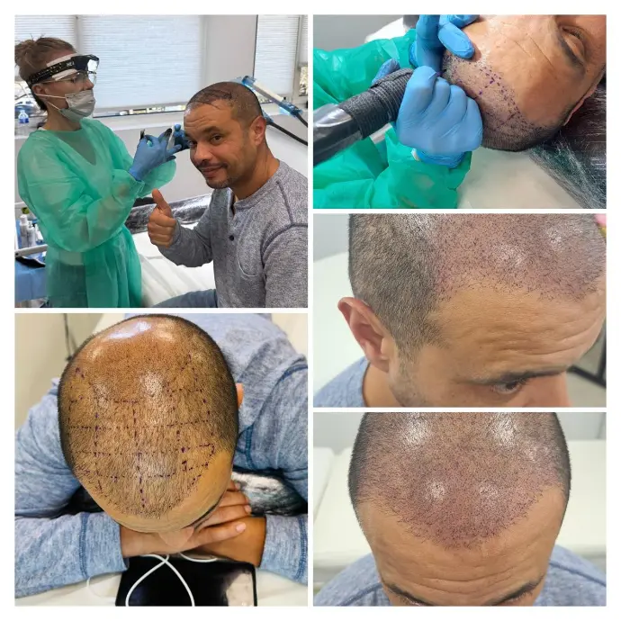 Étapes de tricopigmentation capillaire sur patient avec calvitie frontale et vertex : marquages, séance et résultats immédiats.