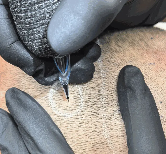 Gros plan sur l’aiguille de tricopigmentation implantant un pigment capillaire.
