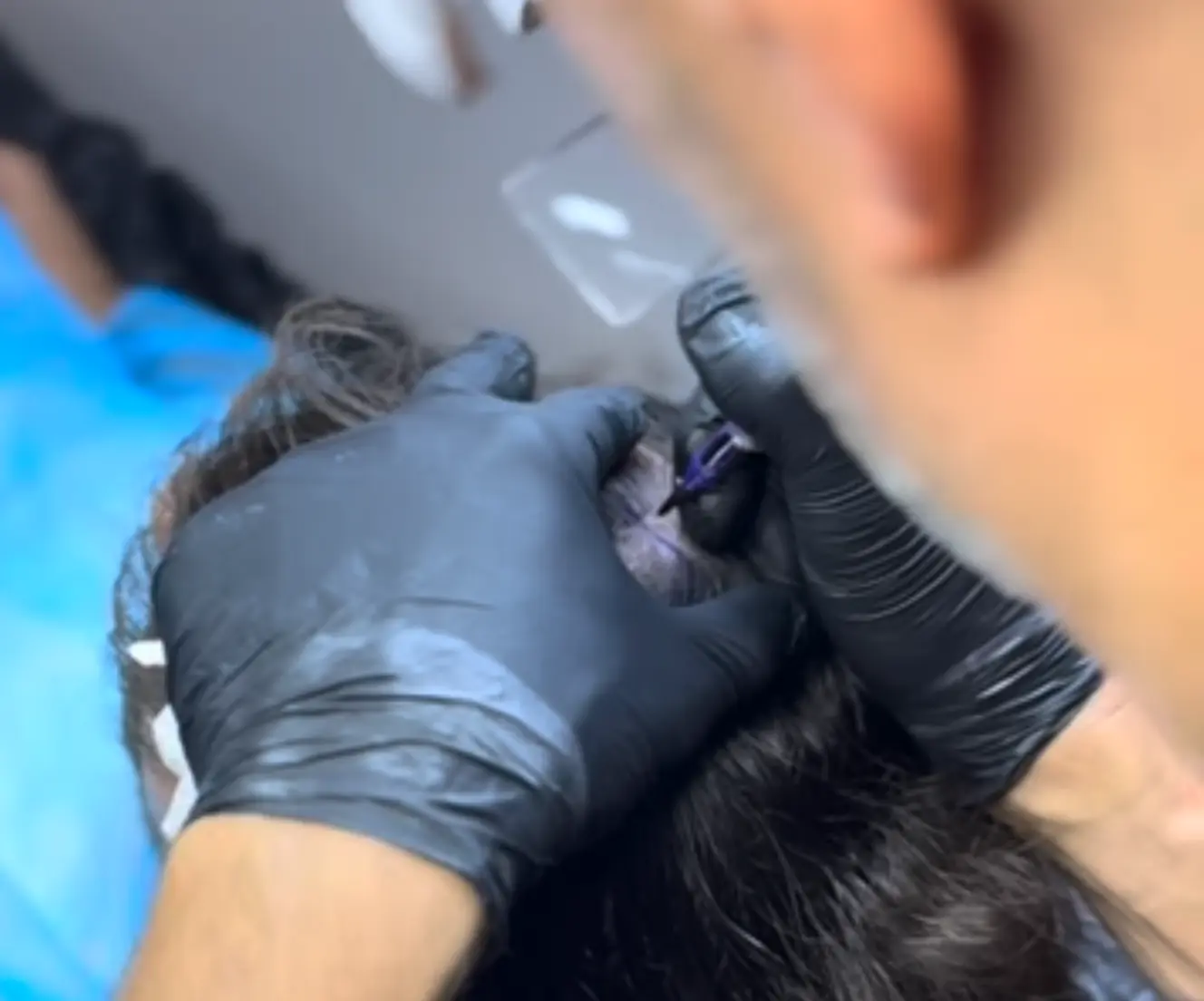 Praticien réalisant une tricopigmentation capillaire de densité