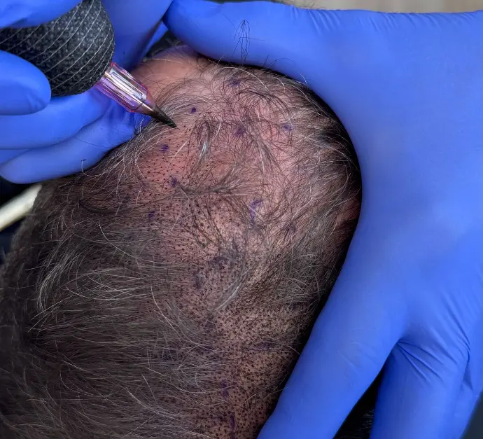 Gros plan sur l’aiguille de tricopigmentation implantant un pigment capillaire.