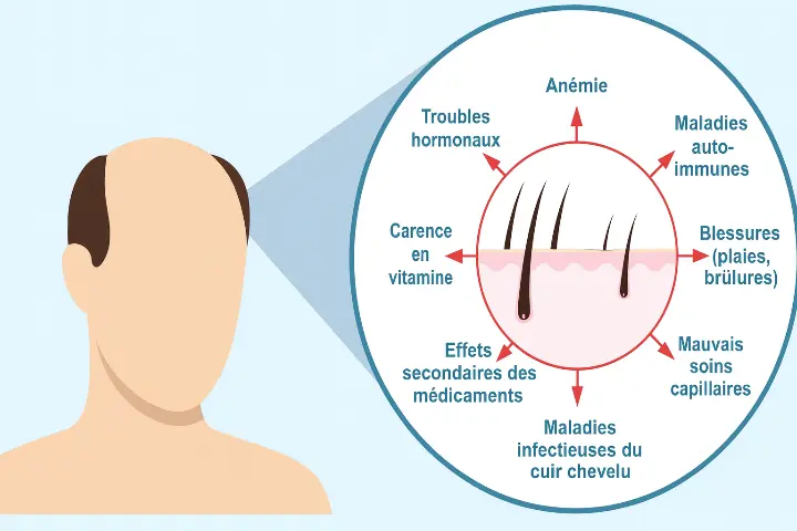 Infographie illustrant les causes de la chute de cheveux : anémie, hormones, carences, maladies, blessures, médicaments.