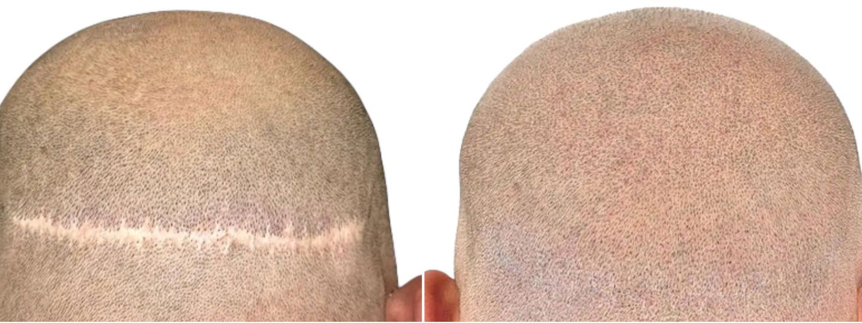 Résultat avant/après tricopigmentation capillaire sur crâne avec cicatrice étendue avec effet homogène.