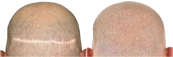 avant et après tricopigmentation capillaire cicatrices après greffes