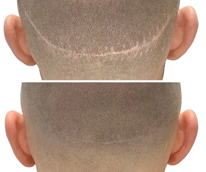 Camouflage d’une cicatrice post-greffe FUE grâce à la tricopigmentation capillaire.