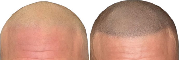 avant et après tricopigmentation capillaire effet crâne rasé