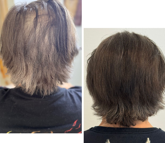 Résultat avant et après densité cheveux longs sur alopécie diffuse