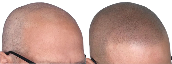 avant et après tricopigmentation capillaire effet crâne rasé