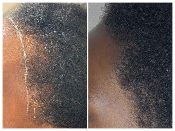 Correction de traction capillaire féminine sur cheveux crépus avec tricopigmentation capillaire.