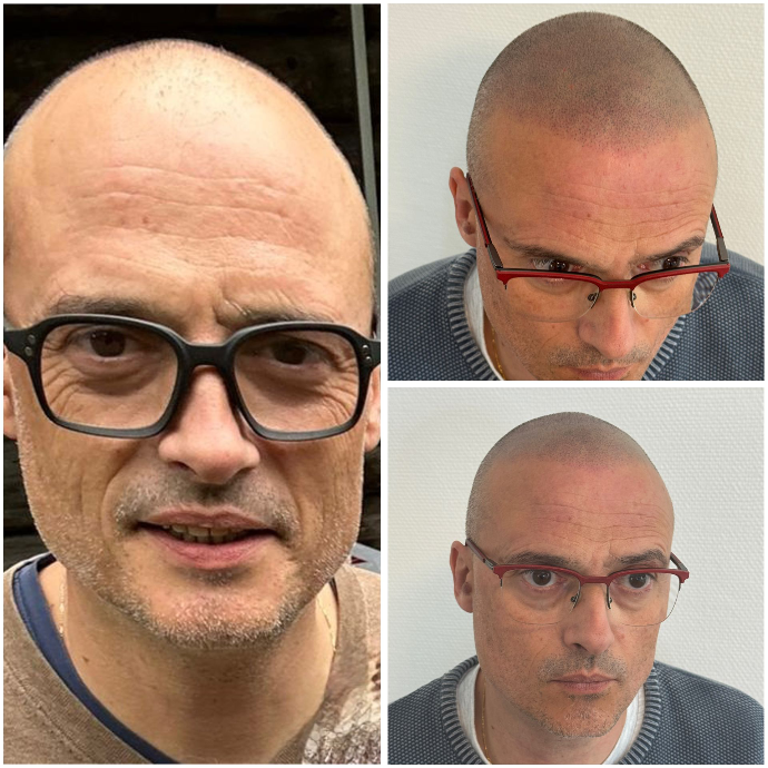 Résultat avant et après tricopigmentation capillaire effet crâne rasé naturel.