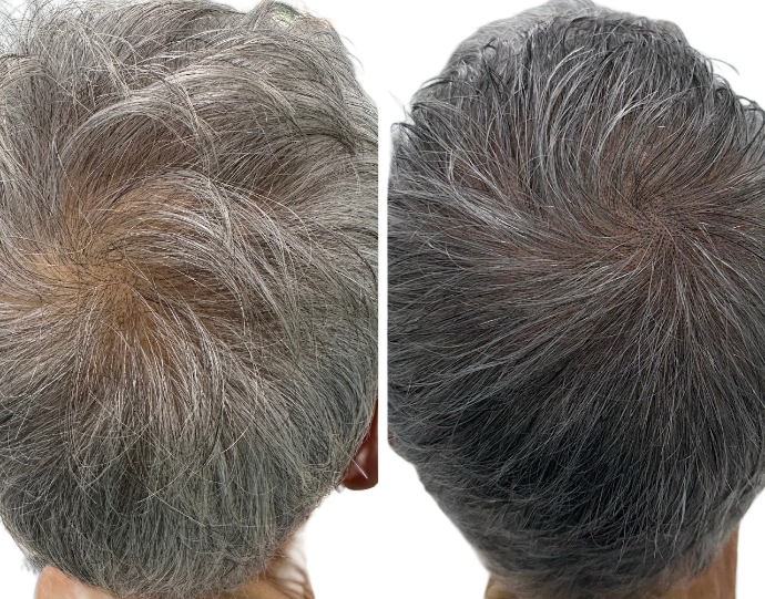 Résultat avant et après densité cheveux longs sur alopécie diffuse