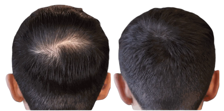 Résultat tricopigmentation capillaire densité