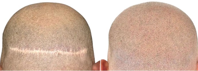 Résultat tricopigmentation capillaire sur crâne avec cicatrices