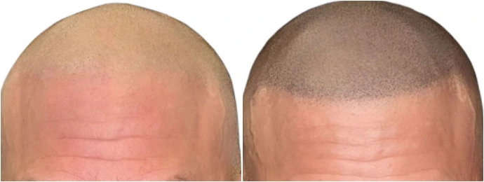 avant et après tricopigmentation capillaire effet crâne rasé