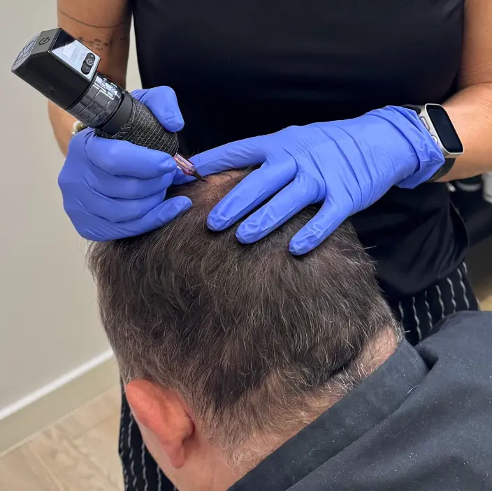 Séance de densité de  tricopigmentation capillaire sur patient atteint de calvitie