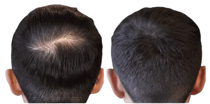 Résultat avant/après tricopigmentation capillaire pour densifier les cheveux clairsemés.