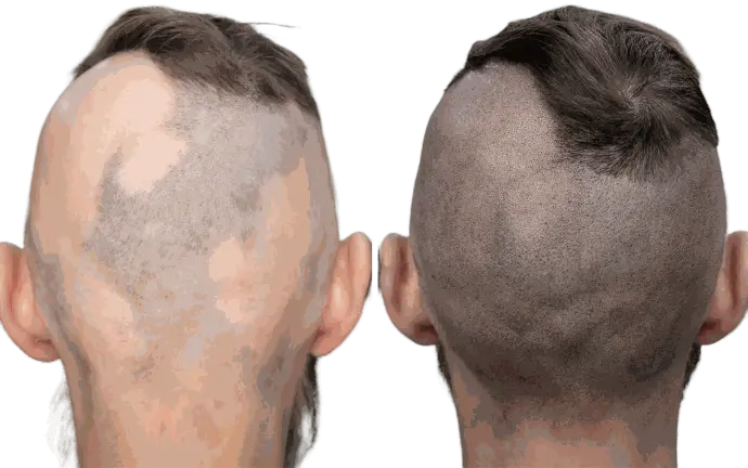 Résultat avant/après tricopigmentation capillaire sur pelade étendue à l’arrière du crâne.