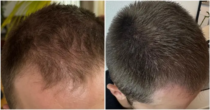 Résultat tricopigmentation capillaire densité